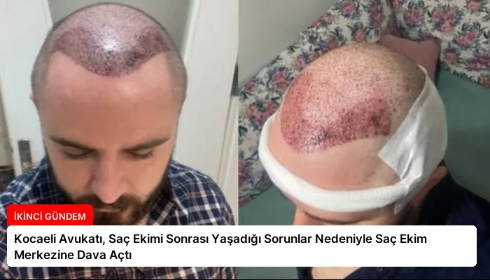 Kocaeli Avukatı, Saç Ekimi Sonrası Yaşadığı Sorunlar Nedeniyle Saç Ekim Merkezine Dava Açtı