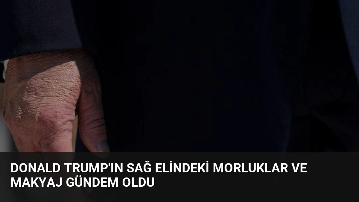 Donald Trump’ın Sağ Elindeki Morluklar ve Makyaj Gündem Oldu